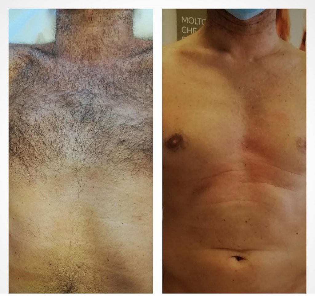 epilazione laser diodo 808 esteticamya