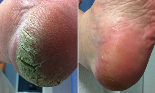 Pedicure Metodo Callus Peeling