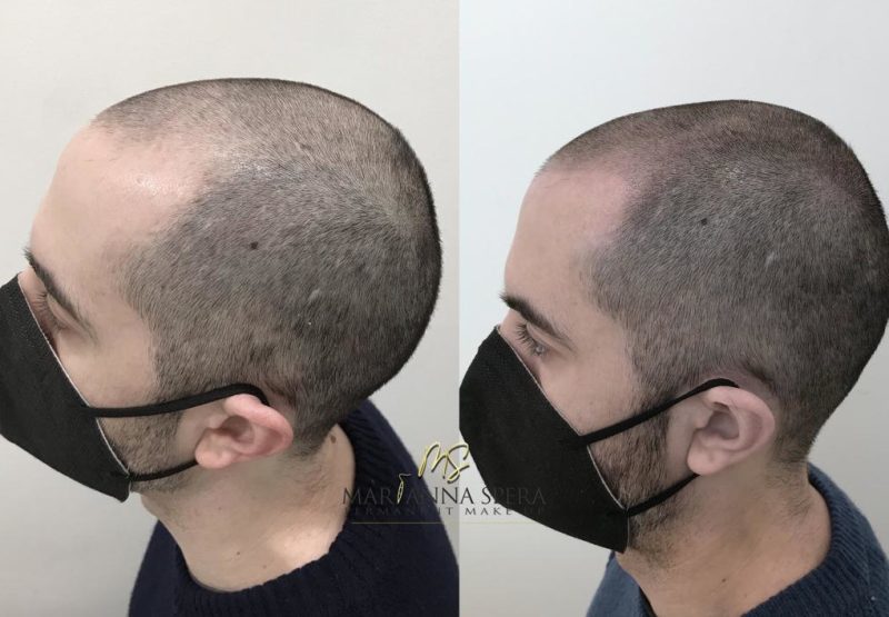Tricopigmentazione Estetica Mya
