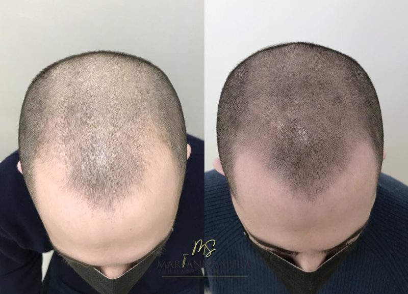 Tricopigmentazione Estetica Mya