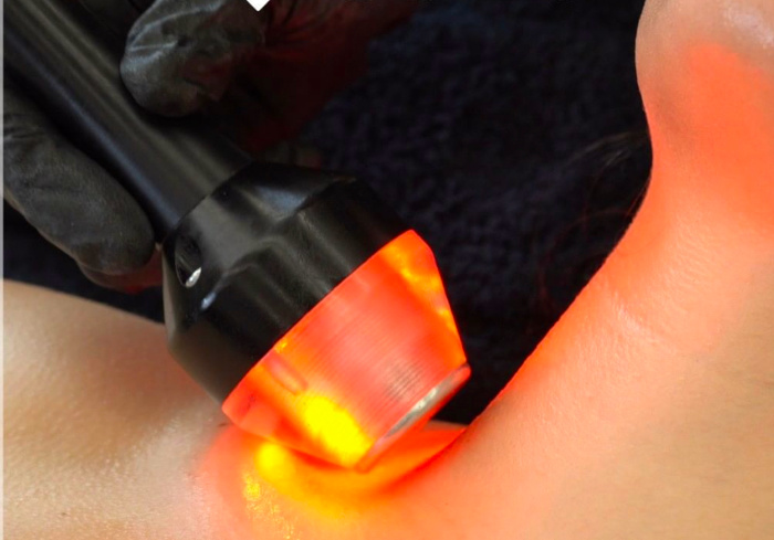 radiofrequenza esteticamya